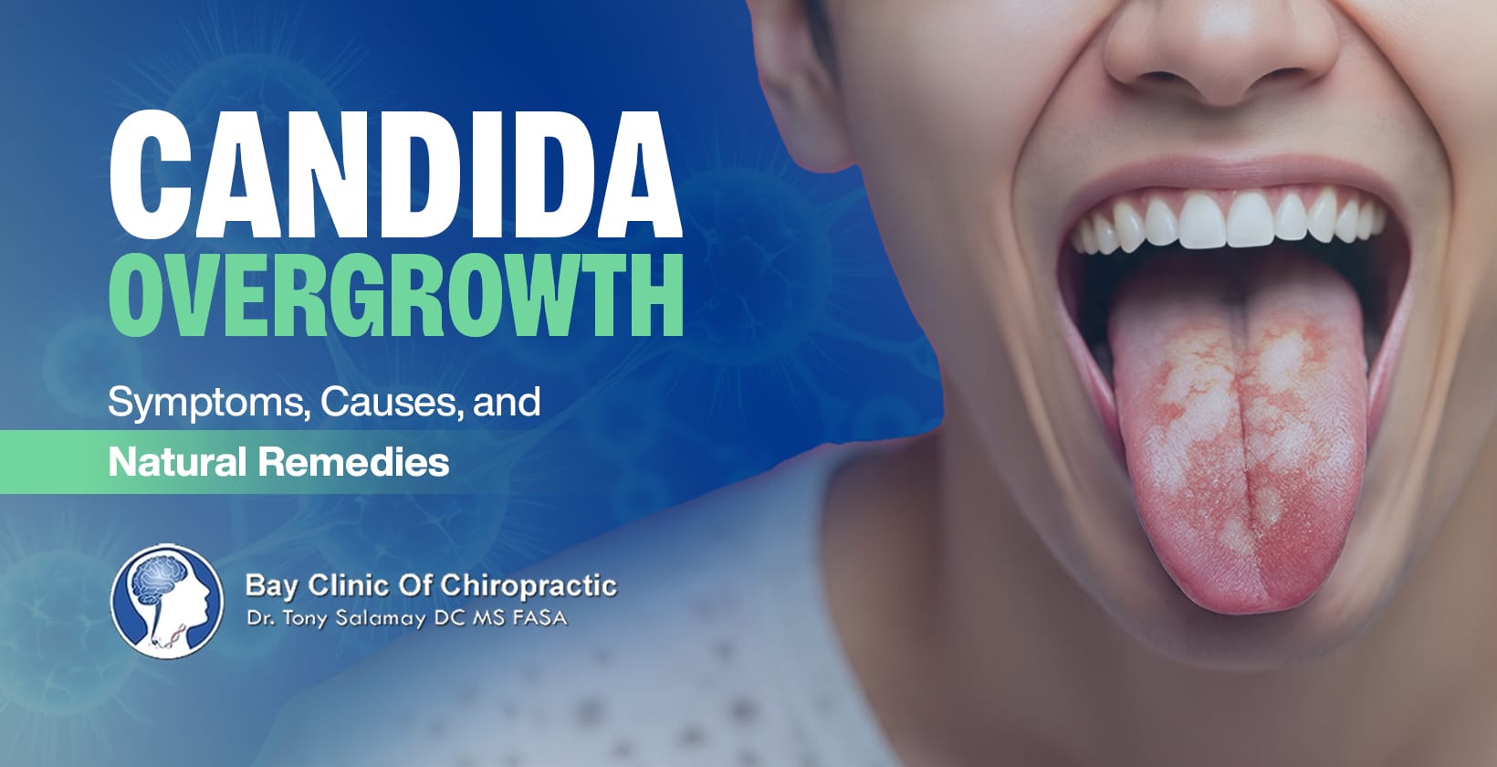 candida overgrowth natural treatments