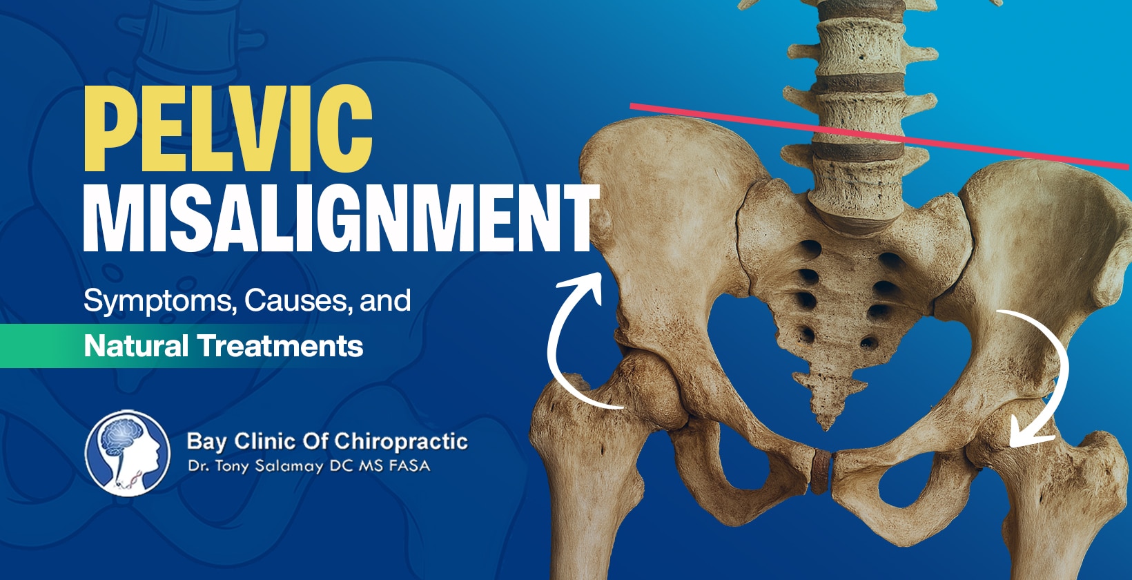 Pelvic Misalignment natural treatment