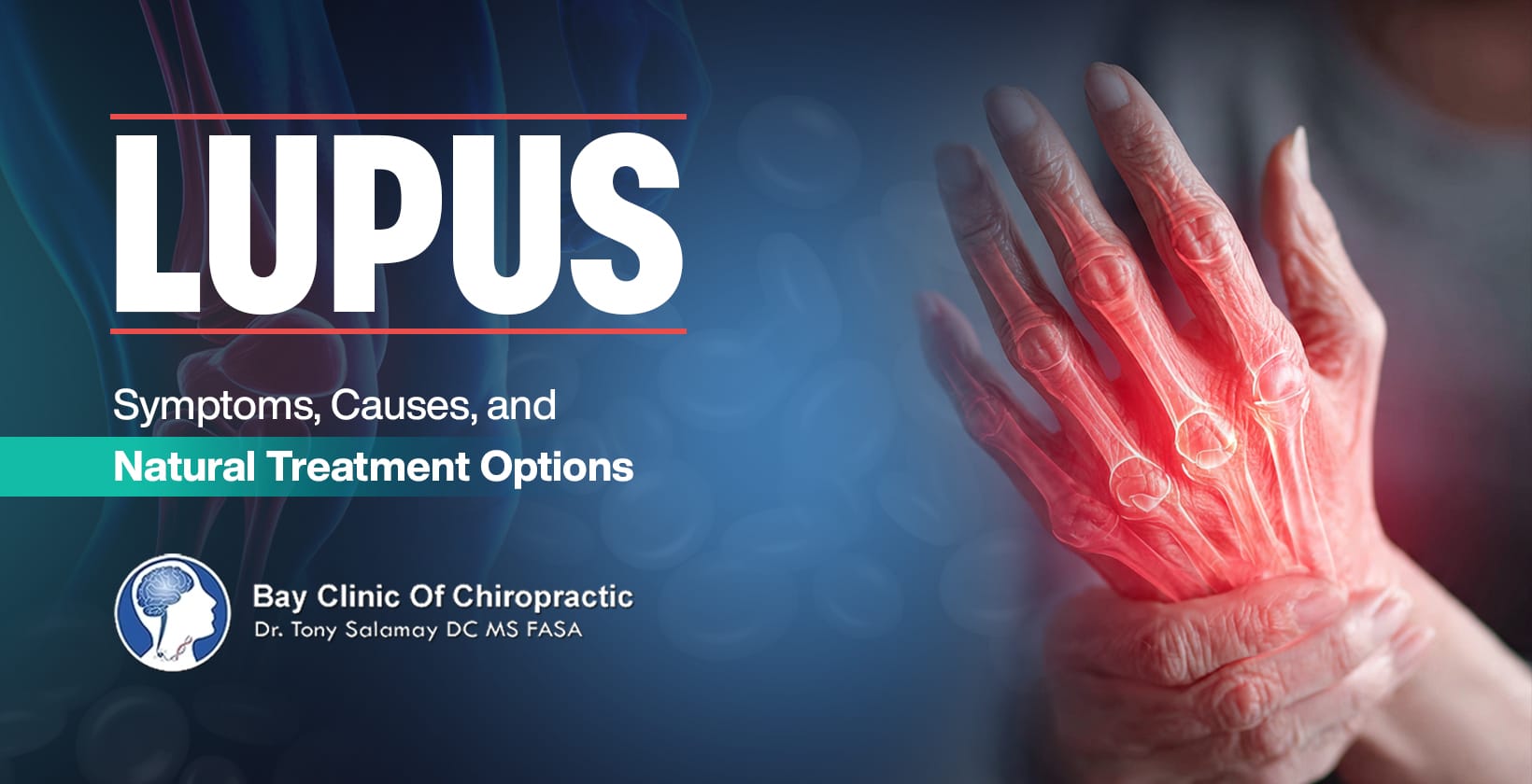 lupus natural treatment