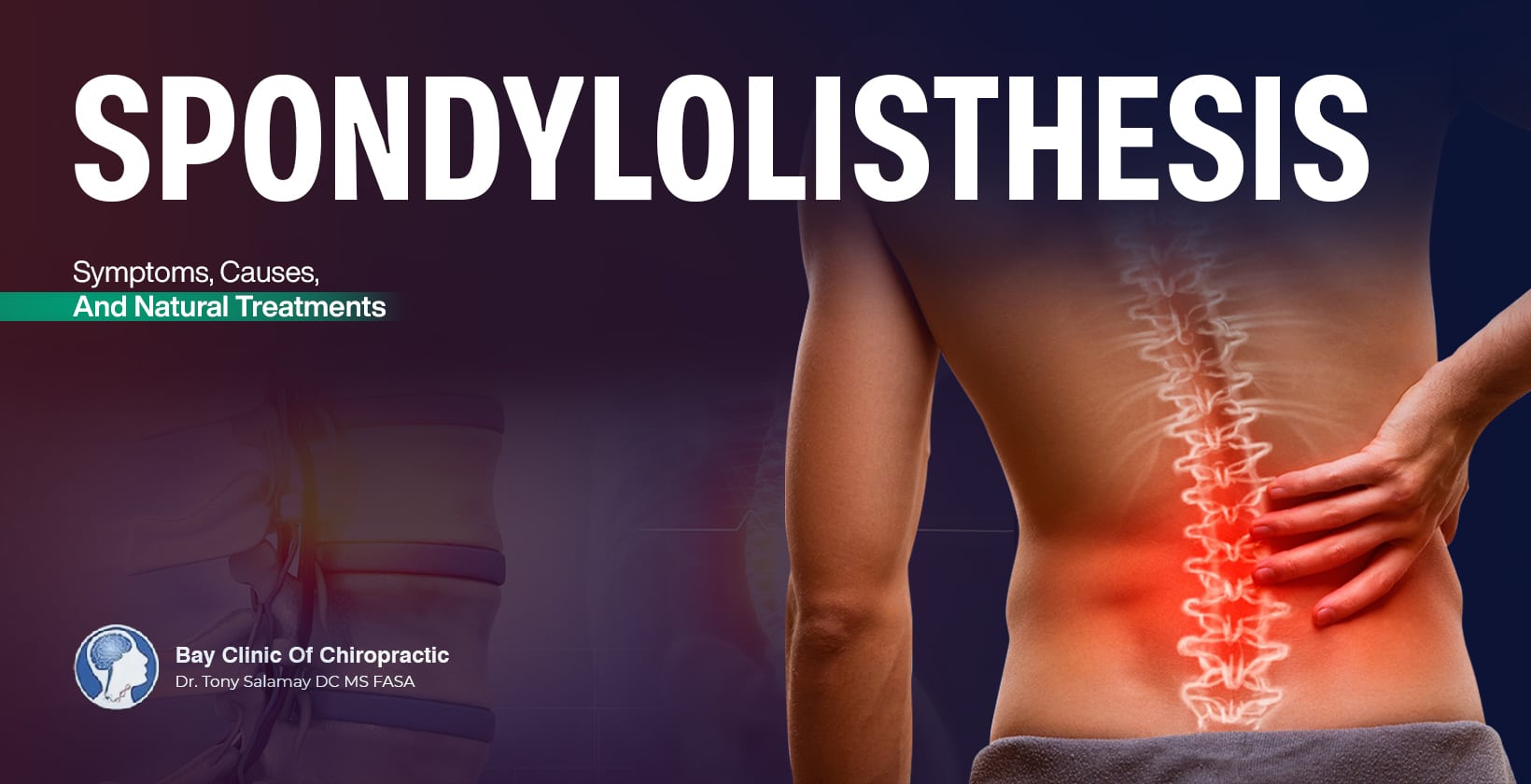 spondylolisthesis natural treatment