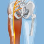 Spinal Decompression for reducing nerve compression